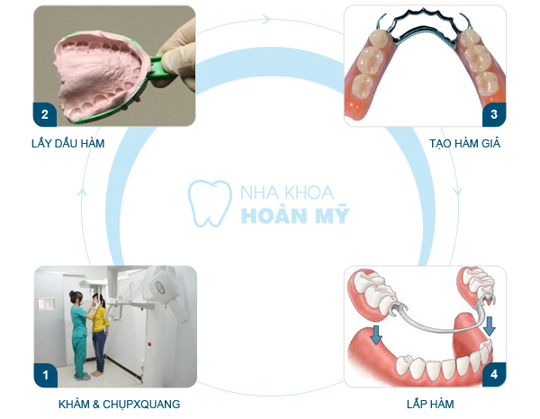 Phục hình răng mất bằng phương pháp làm hàm răng giả4 Phục hình răng mất bằng phương pháp làm hàm răng giả4