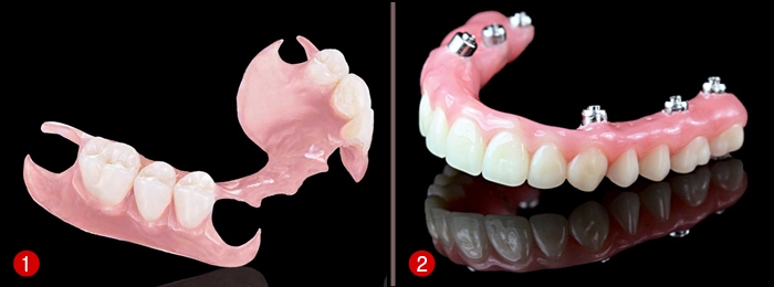 Phục hình răng đã mất bằng hàm giả tháo lắp Phục hình răng đã mất bằng hàm giả tháo lắp