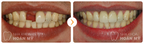 Có nên trồng răng sứ thay thế cho răng thật không?