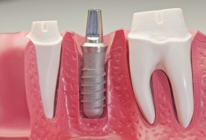 cấy răng Implant thành công