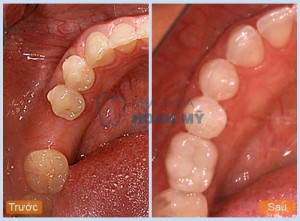 Đoàn Hồng Hải: Trồng răng Implant 1