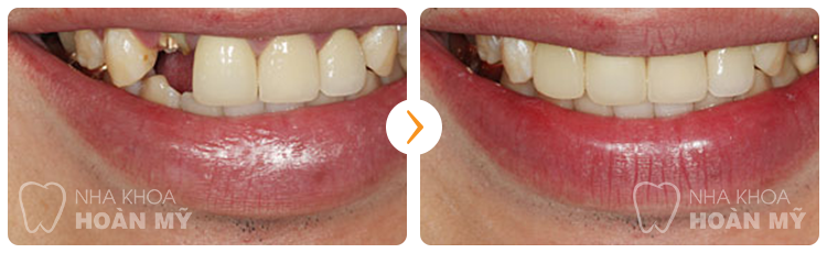 Nha khoa nào cấy ghép răng Implant tại Hà Nội tốt nhất 5 Nha khoa nào cấy ghép răng Implant tại Hà Nội tốt nhất 5