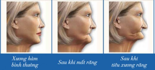 Phương pháp Trồng Răng Mất Toàn Hàm đảm bảo tốt nhất