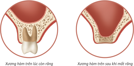 Ghép xương khi trồng răng Implant & những điều cần biết - ảnh 1