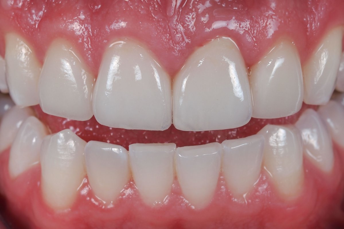 Image result for sưng nướu răng sau khi làm sứ
