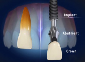 địa chỉ trồng răng implant ở đâu tốt nhất Hà Nội