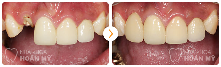 Làm cầu răng có tốt không và độ bền bao lâu?