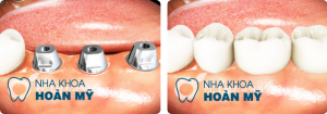 Địa chỉ làm răng implant ở đâu tốt và uy tín Địa chỉ làm răng implant ở đâu tốt và uy tín