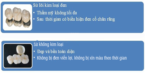 [Câu hỏi thường gặp] giá trồng răng giả các loại hết bao nhiêu tiền? 2