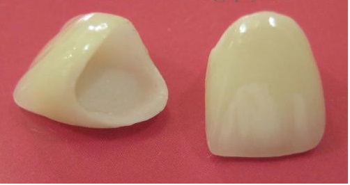 Làm mão răng sứ - Khắc phục răng xấu và xỉn màu 2