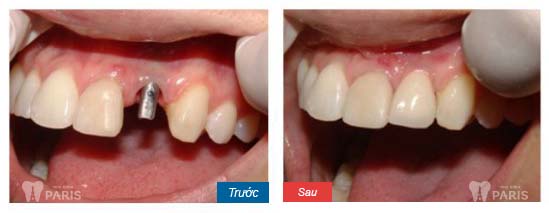 Nha khoa Paris - Địa chỉ làm răng nanh giả chất lượng tốt nhất