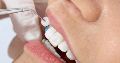 Cách phục hình răng hàm số 7 hiệu quả nhanh nhất hiện nay 1