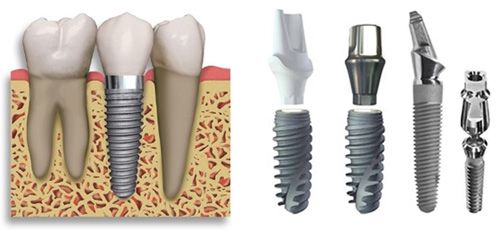Tại sao cấy răng implant cần có bác sĩ giỏi? – Nha khoa Paris