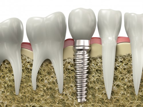 Ghép răng implant có đau không?