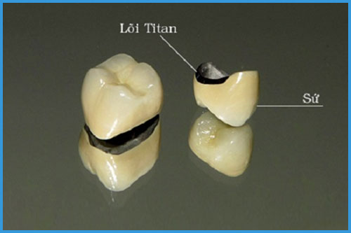 Nên trồng răng giả loại nào tốt và bền chắc nhất hiện nay? 2