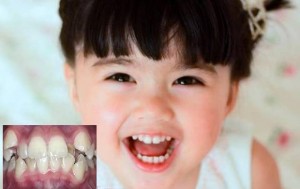 Răng mọc lệch ở trẻ em nên điều trị như thế nào?