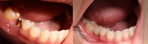 Cảnh báo những hậu quả nghiêm trọng khi mất răng lâu năm 5