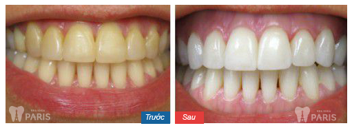 Đắp răng giả bằng sứ cho răng nhiễm màu 