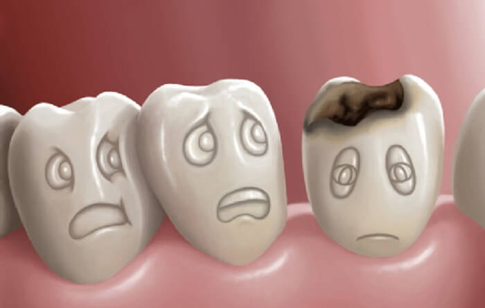Giải đáp thắc mắc: Nhổ răng sâu có ảnh hưởng gì không?