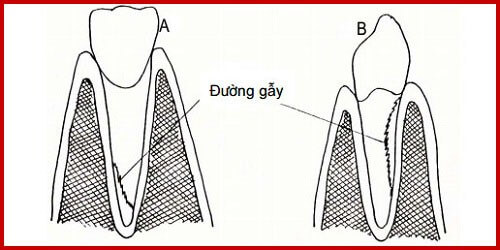 Gãy chân răng và top 4 điều cần tuyệt đối lưu ý