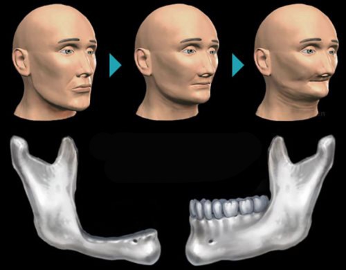 Cơ chế tiêu xương ổ răng 1 