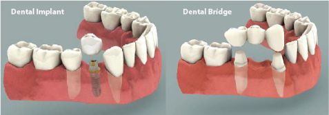Những trường hợp nào nên trồng răng Implant là tốt nhất? 1