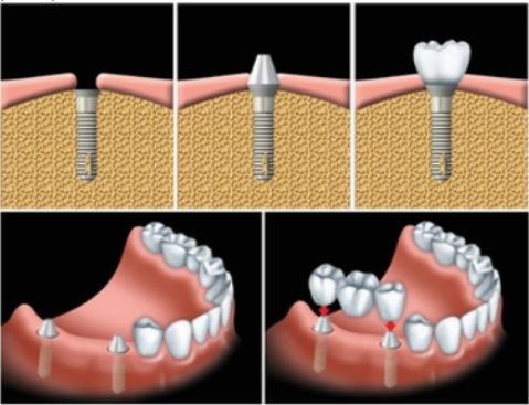 Những trường hợp nào nên trồng răng Implant là tốt nhất? 2