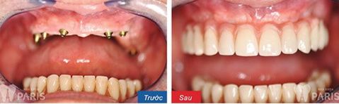 Hàm răng giả tháo lắp và các thông tin hữu ích bạn cần biết 4 Hàm răng giả tháo lắp và các thông tin hữu ích bạn cần biết 4