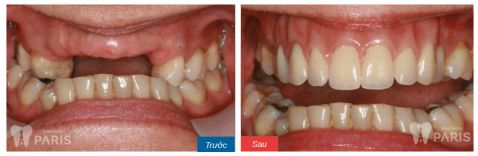 Hàm răng giả tháo lắp và các thông tin hữu ích bạn cần biết 6 Hàm răng giả tháo lắp và các thông tin hữu ích bạn cần biết 6