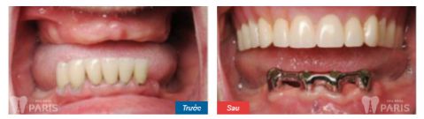 Hàm răng giả tháo lắp và các thông tin hữu ích bạn cần biết 5 Hàm răng giả tháo lắp và các thông tin hữu ích bạn cần biết 5