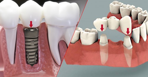 Làm răng giả cần có chi phí là bao nhiêu để trồng răng vĩnh viễn 1