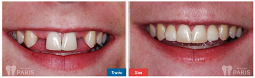 Trồng răng trong bao lâu với từng phương pháp cụ thể? 2