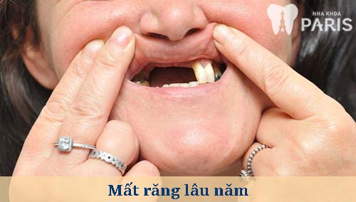 Cảnh báo những hậu quả nghiêm trọng khi mất răng lâu năm 1