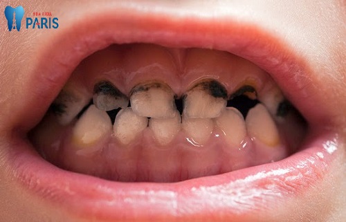 Xiết ăn răng ở trẻ em là gì? Cách khắc phục hiệu quả