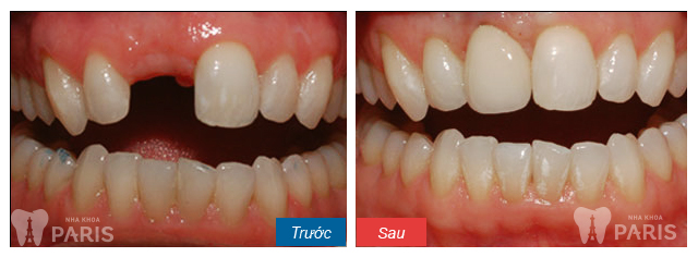 Dental-Work-before-after-06