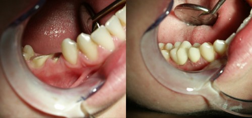 Giá trồng răng Implants bằng công nghệ 4S hết bao nhiêu tiền?