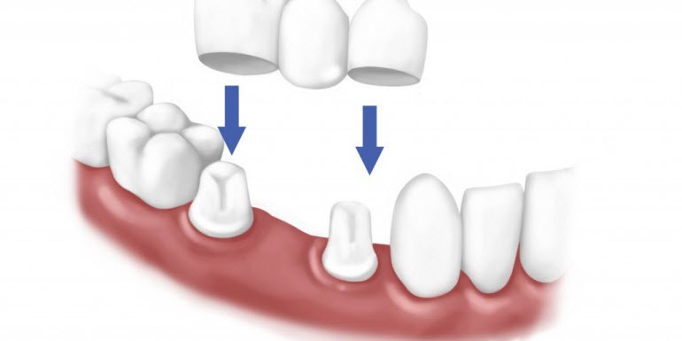 Làm cầu 2 răng mất tại sao lại phải dùng tới 6 răng sứ?