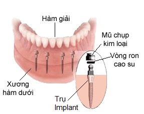 Vì sao làm hàm răng giả cố định lại phải cần đến Implant?