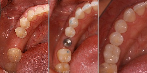 Trồng răng cấm giả An Toàn – Đảm bảo ăn nhai, độ bền Vĩnh Viễn