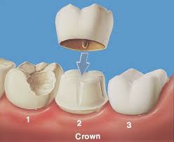 Làm cầu răng có nhược điểm gì? BS tư vấn cách khắc phục tốt nhất 1