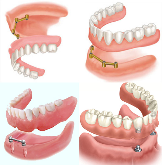Trồng răng toàn hàm trên Implant như thế nào tiết kiệm nhất?