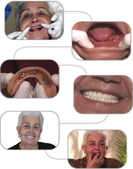 Gần 60 tuổi có thể cấy răng Implant thành công được không?