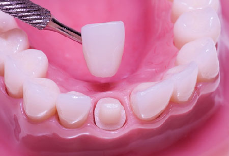 Có nên đi bọc răng sứ cho răng sữa không thay không?
