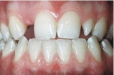 Cách xử lí khi bị thiếu răng hàm trên thế nào?