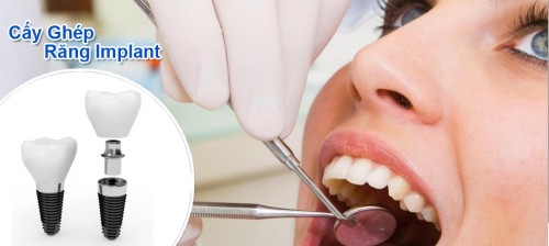 Tại sao răng implant bị đào thải? Cách xử lý như thế nào cho đúng 1