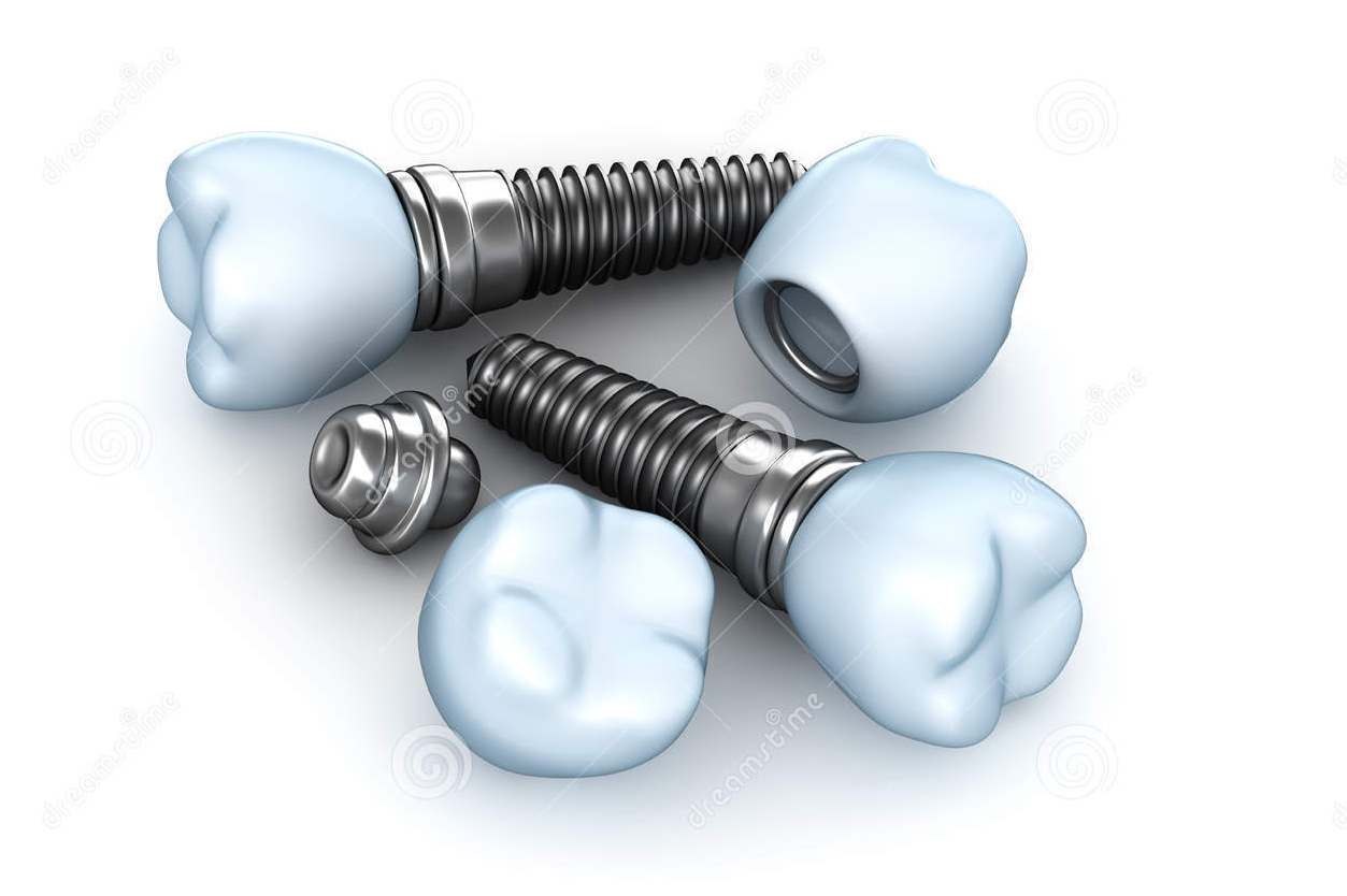 Bảng giá làm răng Implant đầy đủ nhất【Mới nhất & ƯU ĐÃI 2019】
