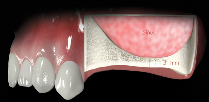 Ghép xương khi cấy răng Implant thực hiện khi nào để tránh tiêu hõm?