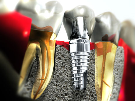 Làm răng Implant an toàn theo tiêu chuẩn “4 Không” an toàn nhất
