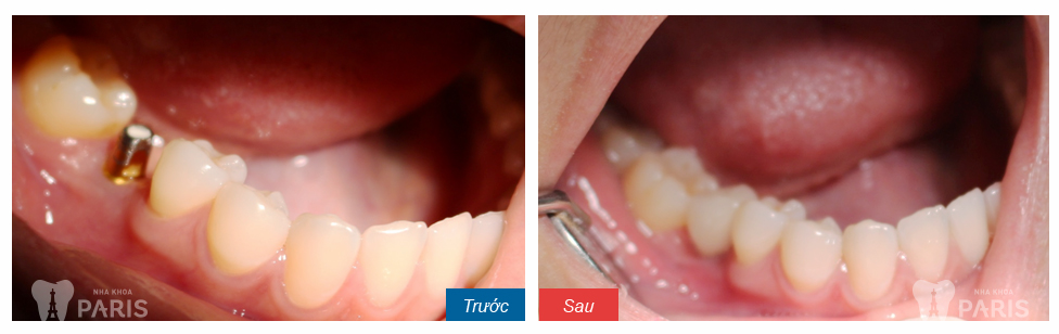 Lời khuyên: Có nên nhổ răng cấm bị sâu hay không? 2