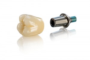 Răng sứ kim loại GIÁ RẺ - CHẤT LƯỢNG cao tại nha khoa Paris - Ảnh 1